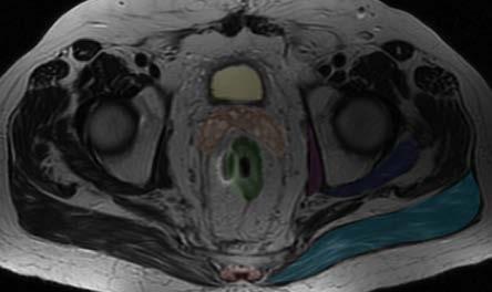 Axial MRI - male