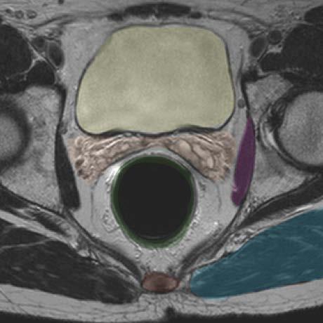 Axial MRI - male Bladder