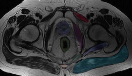Axial MRI - male Pubic