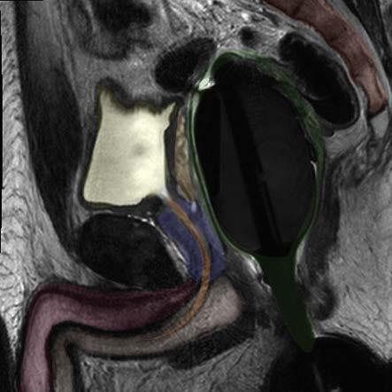 Endo-rectal coil Seminal vesicle Bladder Prostatic Urethra