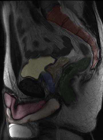 Sagittal MRI - male Seminal vesicle Bladder