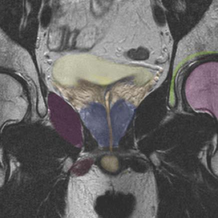 Coronal MRI - male Bladder Obterator Internus muscle Prostatic urethra