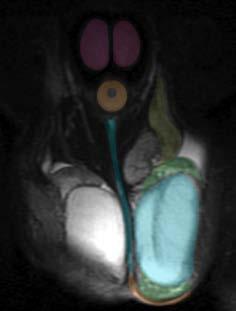 Coronal MRI - male Corpus cavernosum Corpus spongiosum (with urethra)