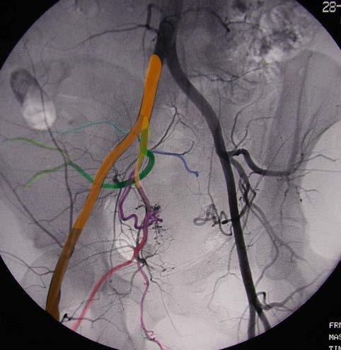Common iliac artery Internal iliac artery Iliolumbar artery Posterior trunk of internal iliac artery Superior gluteal artery Uterine