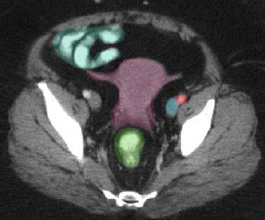 Axial CT - female Sigmoid