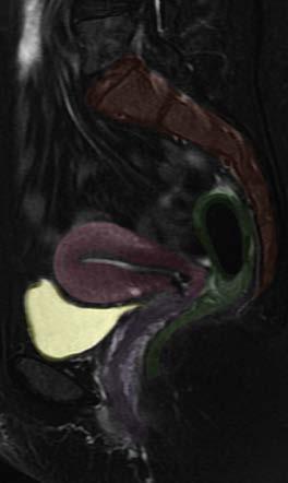 Sagittal MRI - female Recto-uterine pouch Sacrum