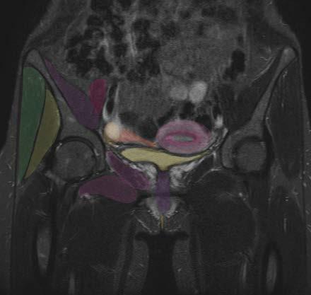 Coronal MRI - female Fallopian tube