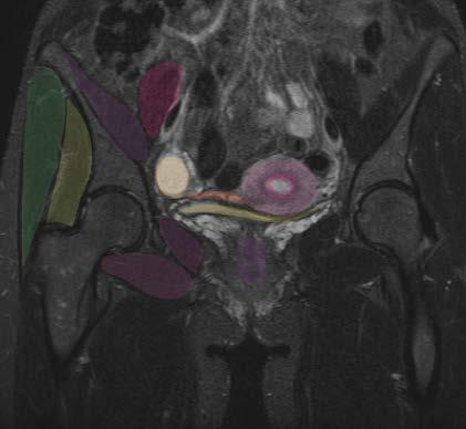 Coronal MRI - female Fallopian