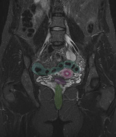 Coronal MRI - female Sigmoid