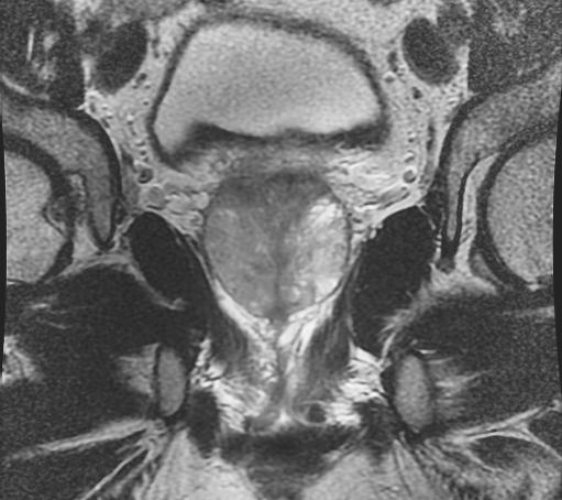 Coronal MRI prostate cancer Infiltrated cancer in right