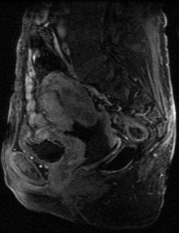 Sagittal MRI cervical cancer Anterior extension into