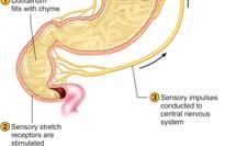2 A Common Problem: Heartburn Stomachache results from eating a lot of food too quickly It takes up to 20 minutes for hypothalamus to sense full stomach Excess fullness leads to abdominal pain and