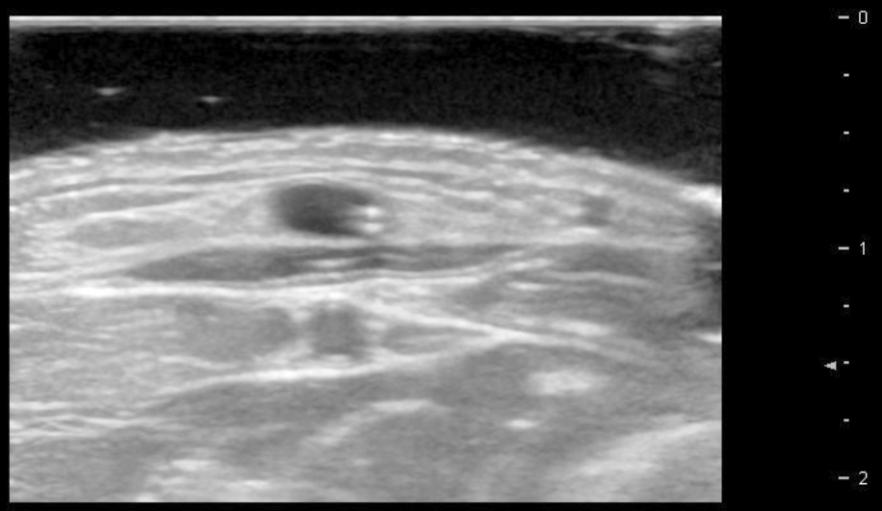 OUR PREVIOUS STUDY We classified US images detected in the study into N=186 PIVC (145 subjects) four types of US features. A: No signs; 51 PIVCs Catheter (25.5%) B: Thrombus ; 48 PIVCs (24.