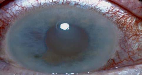 ALPI Tips & Pearls Arcus senilis should be ignored An extremely shallow AC and corneal edema,