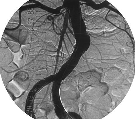 Volume 29, Number 6 Krohg-Sørensen et al 1153 aneurysm sac, posteriorly and 2 cm caudal to the bifurcation behind the stent limbs.