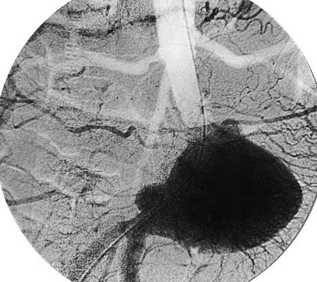 The contrast filling was unchanged through this time, and the aneurysm diameter was stable at 70 mm (Fig 2A).