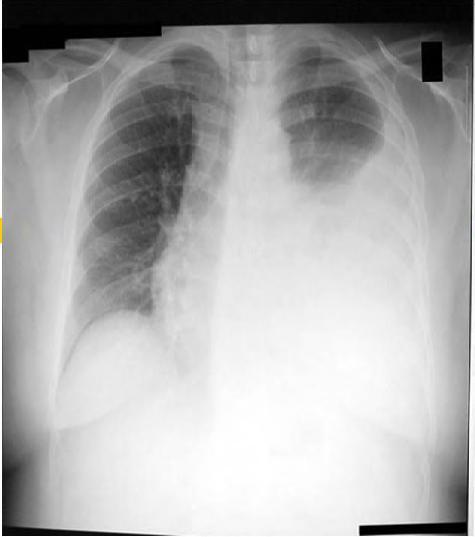PLEURAL TB Diagnosis: Imaging (CXR, sonar, CT scan)