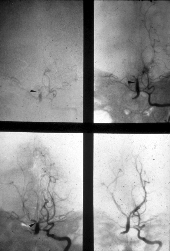 The Early Thrombolysis Cohorts The original 1979 film It all started with pilot cases of intraarterial thrombolytic therapy in cases with acute basilar artery occlusion, and otherwise deadly