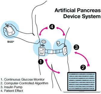 Types of Artificial Pancreas Device Systems (APDS) CTR (Control to Range) Hypoglycemia Pump Shut off (Choudhary et al 2011) Hyperglycemia CTT