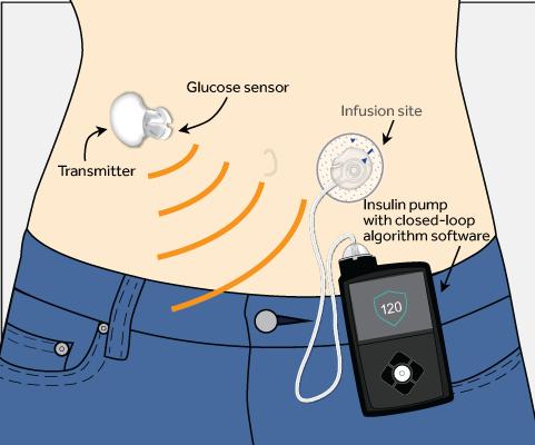 SYSTEM COMPONENTS The MDT 670G system included the new pump platform, closedloop algorithm, and CGM display for the investigational 4 th - generation subcutaneous glucose sensor and transmitter.