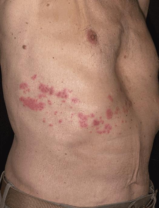 Special Vaccine Considerations: If not on immunosuppressant medicine: Consider Zostavax (shingles vaccine) if 60 years old 20% of lupus patients get shingles Causes a severe, painful rash Pain can