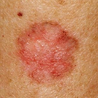 malignant tumors. Damage is generally caused by ultraviolet radiation (UVA and UVB) from the sun or indoor tanning beds.