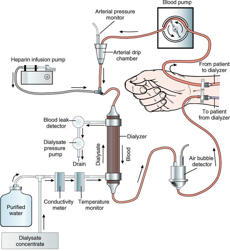 19 Renal Dialysis Renal Dialysis (cont Removal of toxins from blood when kidneys are unable; two main types: Hemodialysis Peritoneal dialysis Hemodialysis external machine filters blood Peritoneal