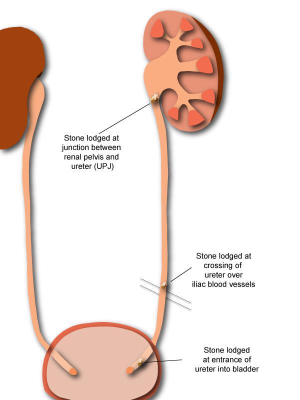 Where kidney stones get stuck?