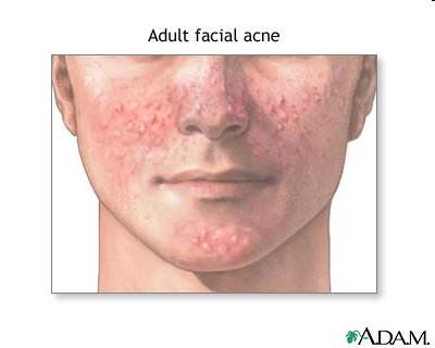 Primary acute bacterial skin
