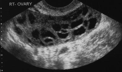 Disorders of male and female sex hormones 15 Figure 1. Ultrasound of a polycystic ovary showing multiple follicles in a peripheral distribution.