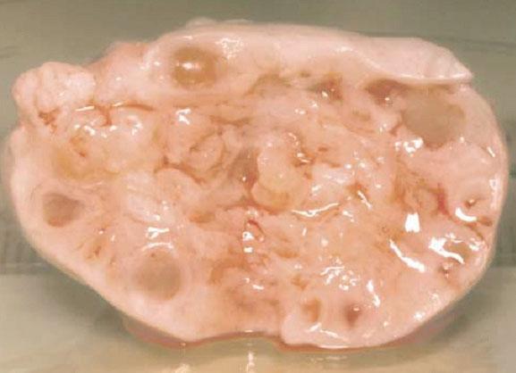This is compounded by obesity, which causes an increase in insulin resistance, making the problem worse. Figure 2. Gross anatomical specimen showing peripheral follicles in a polycystic ovary.