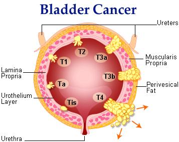 Ta: Superficial cancer is found only in polyps (papillary) on the surface of the inner lining of the bladder. Lymph nodes are not involved and cancer has not spread (metastasized).