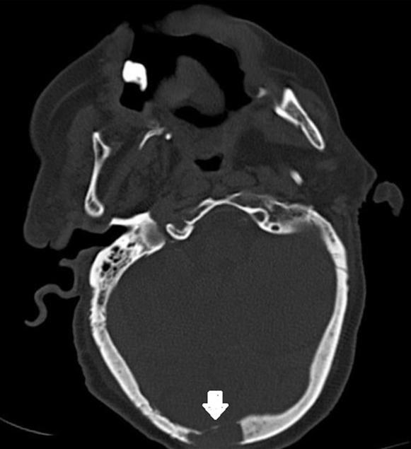 80 Figure 1: A 98-year-old female presented to emergency with altered sensorium showing solitary osteolytic skull metastasis in a case of unknown primary being latter diagnosed as carcinoma of gall
