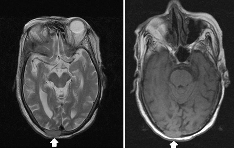 2a 2b Figure 2a-2b: A 98-year-old female presented to emergency with altered sensorium showing solitary osteolytic skull metastasis in a case of unknown primary being latter diagnosed as carcinoma of