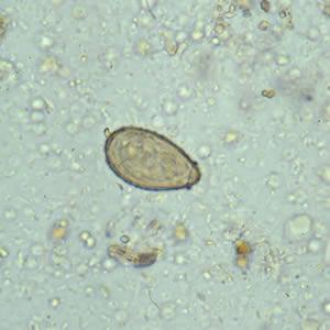 Clonorchiasis Laboratory Diagnosis: Microscopic demonstration of eggs in