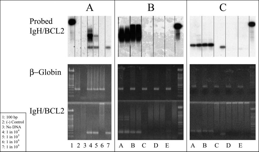 Figure 2. An example of nested polymerase chain reaction (PCR) analysis for detection of minimal residual disease (MRD) in marrows from 2 follicular lymphoma (FL) patients.