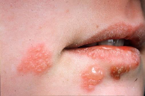 Primary infection with HSV-1 is often asymptomatic.