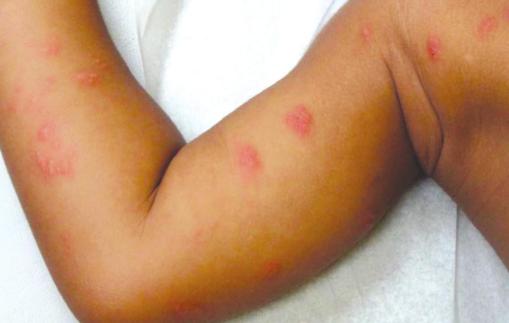 He has been scratching at the lesions, which are limited to his right arm (see Figure 1). He has had a low-grade fever, mild rhinorrhea, and a cough for a week but has been well otherwise.