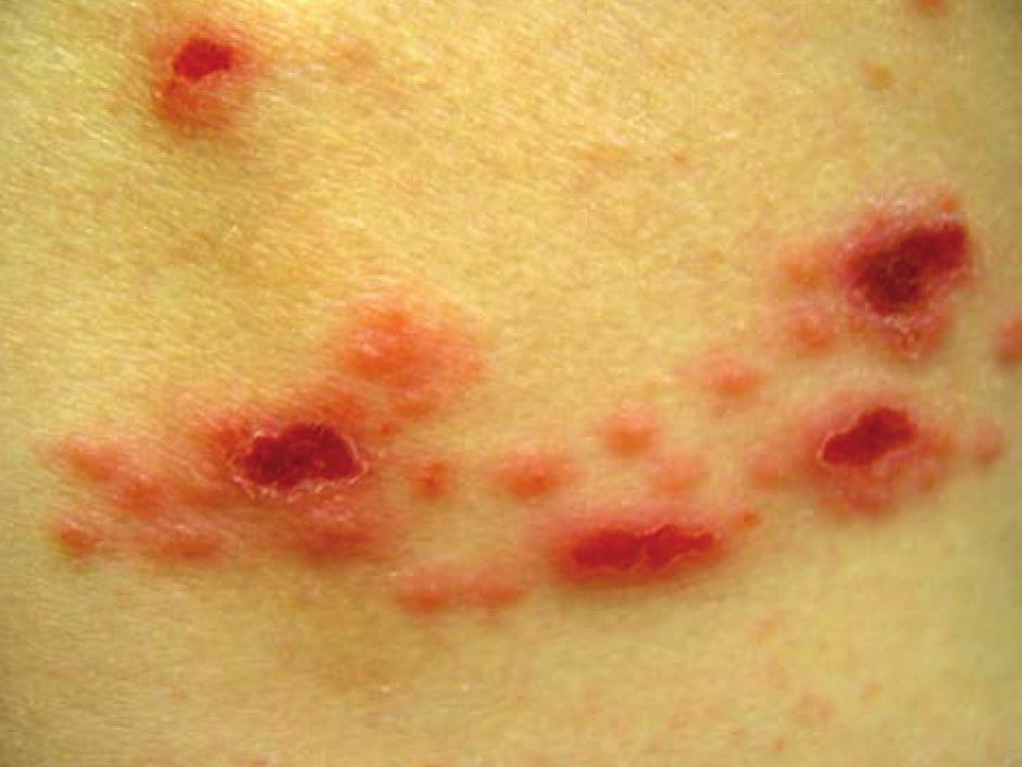 The mother thinks that these lesions may be abrasions. She was also worried about the small blisters on the back, because a child in her daycare had scabies and another child had MRSA.