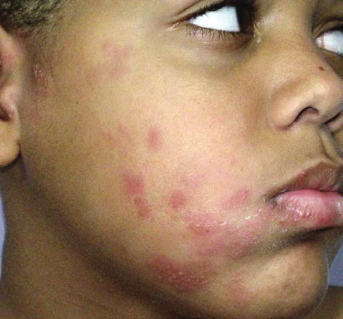 Figure 5. This 10-year-old boy presented with 3 days of painful burning and swelling on the right side of his face, before it erupted with the typical trigeminal dermatome zoster on day 4.