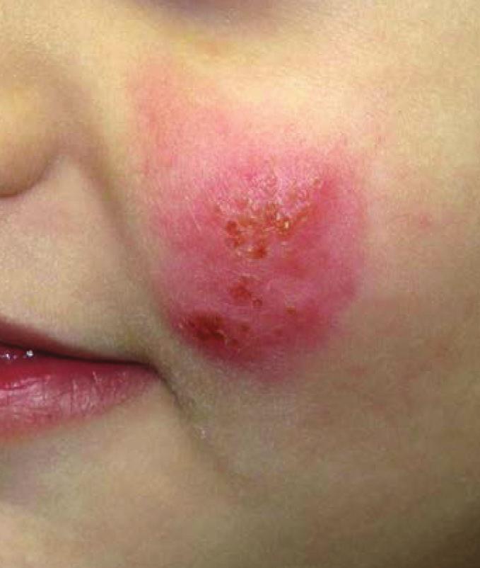 5 The duration of the first-time zoster rash may be from 1 to 3 weeks. Postherpetic neuralgia rarely occurs in children, unlike in adults.