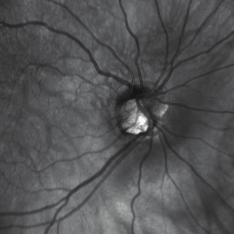 the inferior border of the myopic conus. and 12 mmhg OS. Fundus examination revealed a wellcircumscribed triangular yellow-orange thickening at the inferior border of both optic nerves (Figure 1).