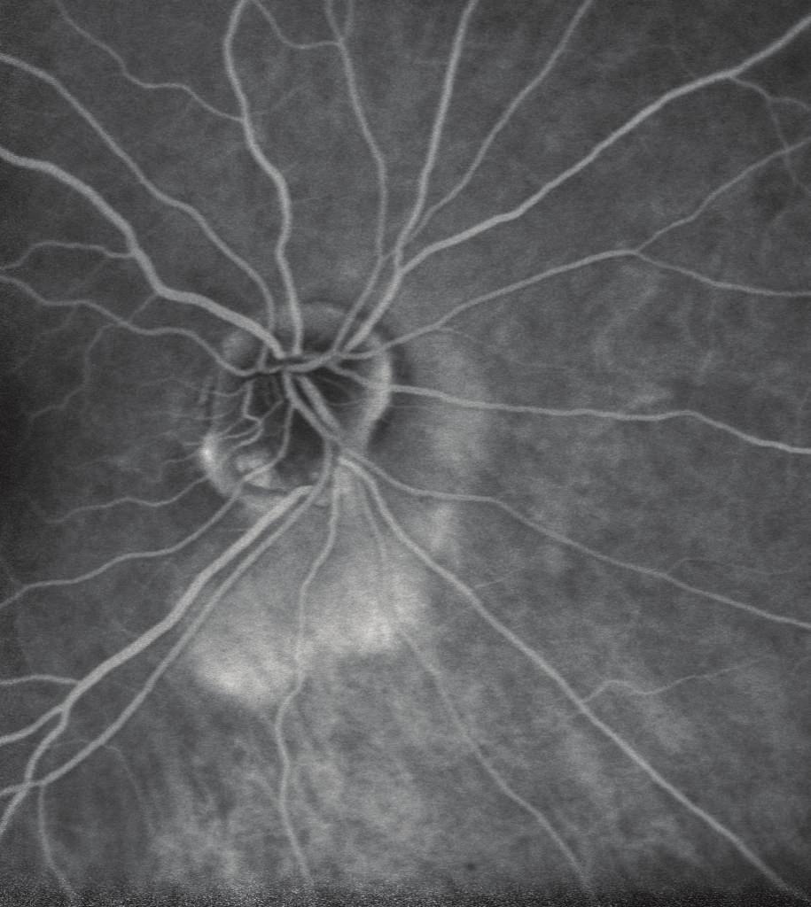 Indocyanine Green Angiography ((d) early stage at 2 minutes, (e) intermediate stage at