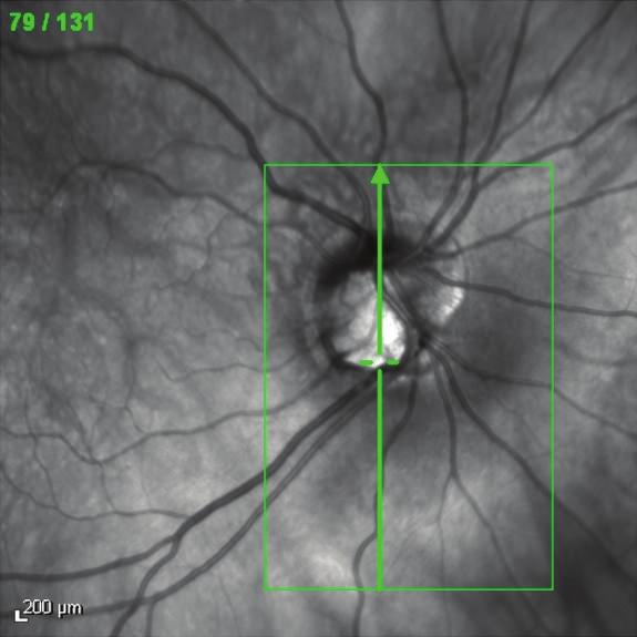 4 Case Reports in Ophthalmological Medicine (a) (b) (c) (d) (e) Figure 3: Infrared imaging (a) with localization of B-scan acquisition within the peripapillary cavitation (green