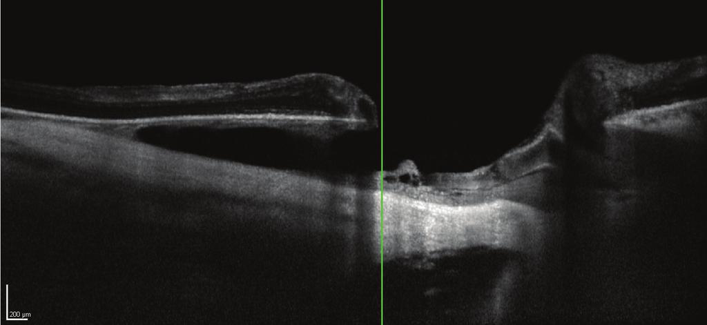 , Peripapillary detachment in pathologic myopia, Archives of Ophthalmology, vol. 121, no. 2, pp. 197 204, 2003. [2] J. Toranzo, S. Y. Cohen, A. Erginay, and A.