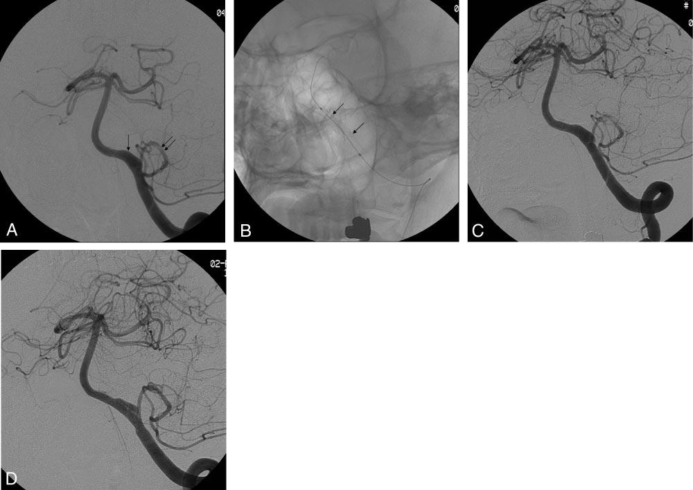Fig 1. Images from the case of a 50-year-old woman (patient 7) who had a fusiform aneurysm of the distal intracranial left vertebral artery.