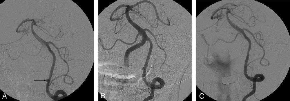 distal to the left posterior inferior cerebellar artery (PICA, double arrows). B, Unsubtracted image demonstrates the deployed stent (arrows) across the aneurysm.