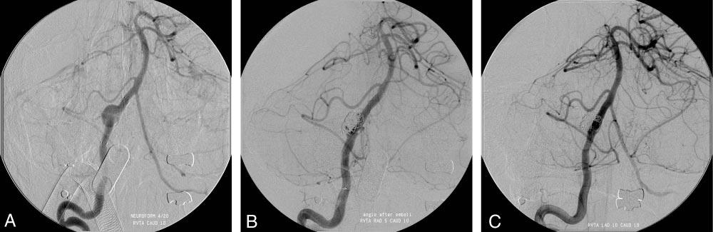 Fig 3. Angiograms in a 52-year-old man (patient 11) with dissecting aneurysm of the distal intracranial right vertebral artery treated with stent-assisted coiling.