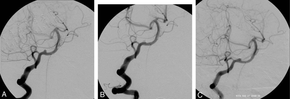 C, Digital subtraction angiogram shows nearly completely occluded aneurysm with preservation of the parent artery. Fig 4.