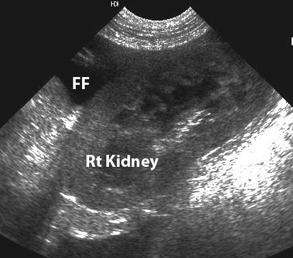 . Fig 3 Abnormal fluid will (FF) located in the renal fossa between the right kidney and the caudate lobe of the liver Fig 4 At location 4, abnormal fluid will outline